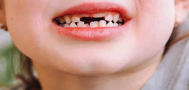 سقوط الأسنان في المنام للعزباء