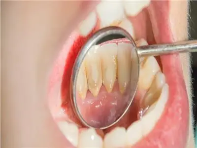 وسائل المحافظة على الأسنان 