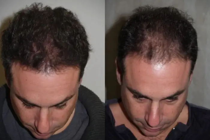 نصائح بعد اجراء زراعة الشعر