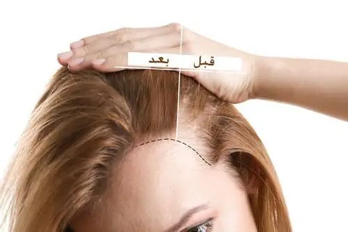 تجربتي في زراعة الشعر للنساء