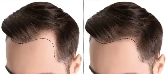 تجربتي في زراعة الشعر