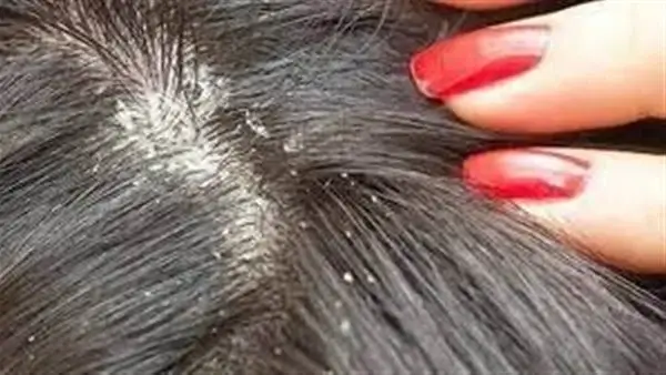 القشرة في المنام